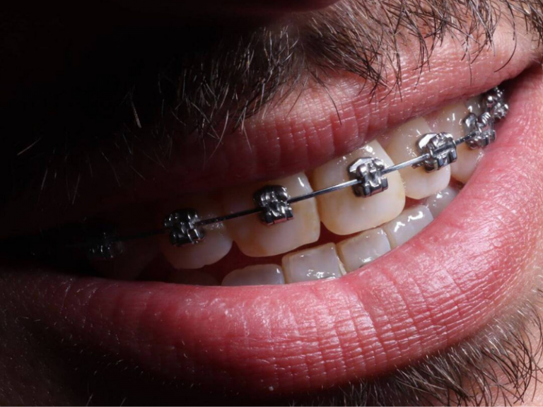 imagem de um dos tipos de aparelhos dentários
