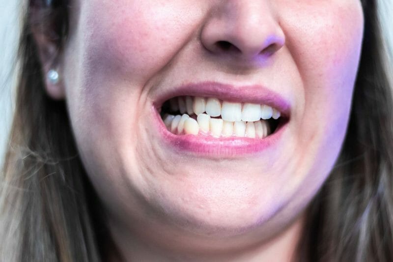 imagem de paciente a ranger os dentes (bruxismo)