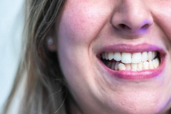 Imagem de paciente a ranger os dentes (bruxismo)