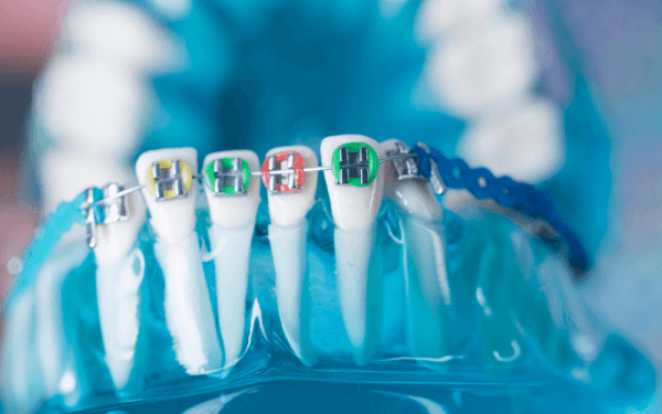 imagem de várias cores para aparelho dentario