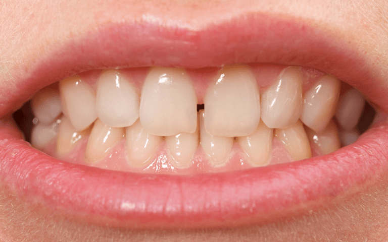 imagem de um caso de diastema