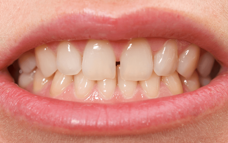 imagem de um caso de diastema