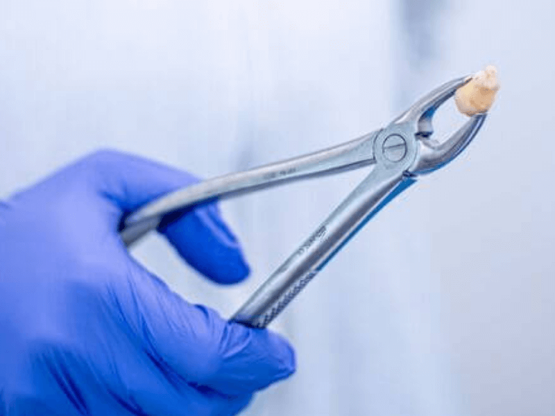 imagem de dente do siso depois de ser extraído