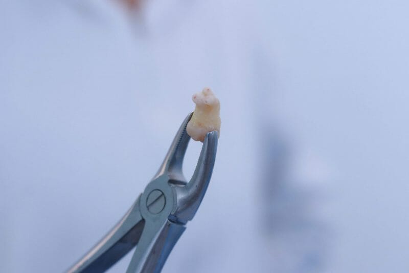 Imagem de um dente extraído
