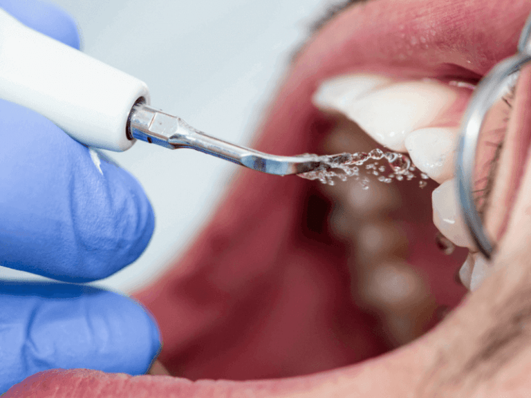 imagem de um paciente a fazer uma limpeza dentária