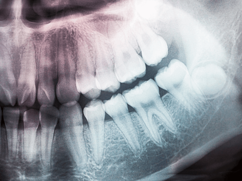 imagem de uma radiografia periapical