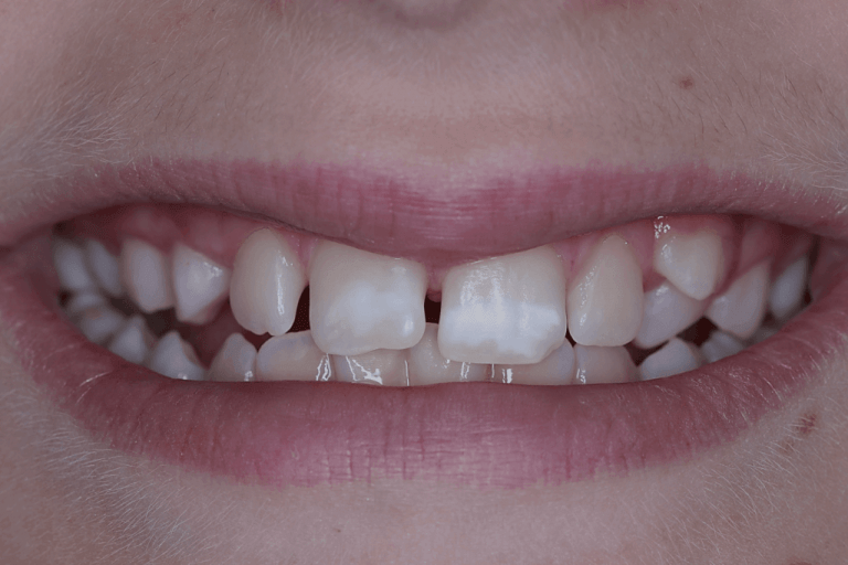 Criança com manchas brancas nos dentes