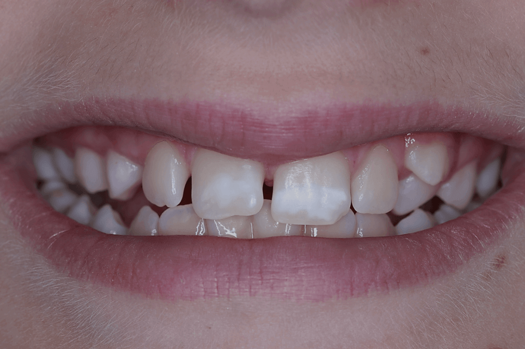 Criança com manchas brancas nos dentes