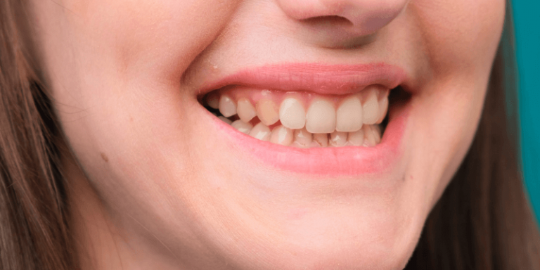 paciente com dentes amarelos