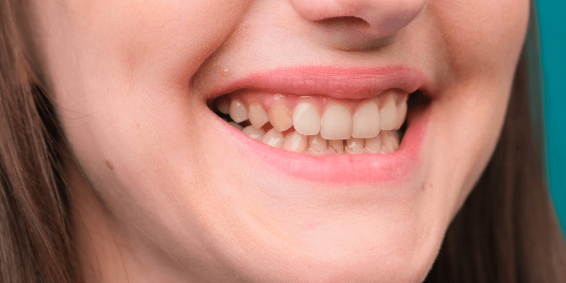 paciente com dentes amarelos