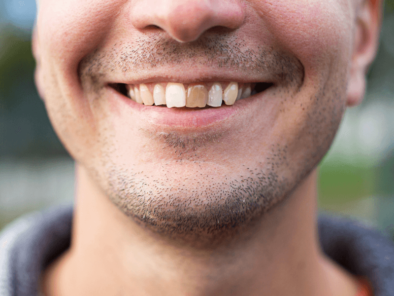 paciente com esmalte dos dentes desgastado
