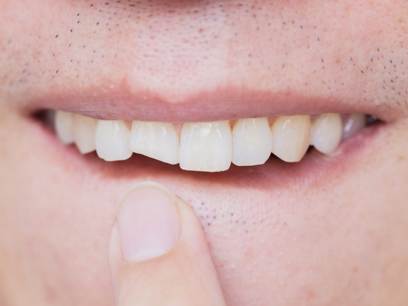 imagem de um dente partido