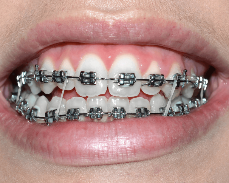 elásticos nos aparelhos dentários