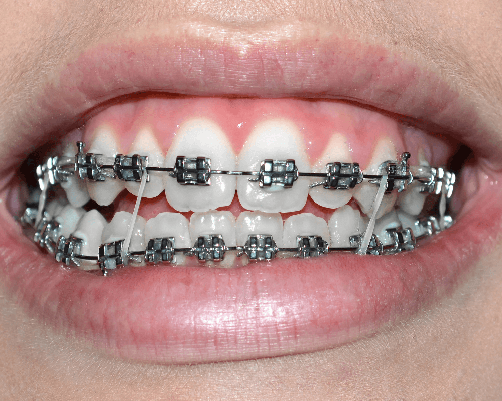 elásticos nos aparelhos dentários